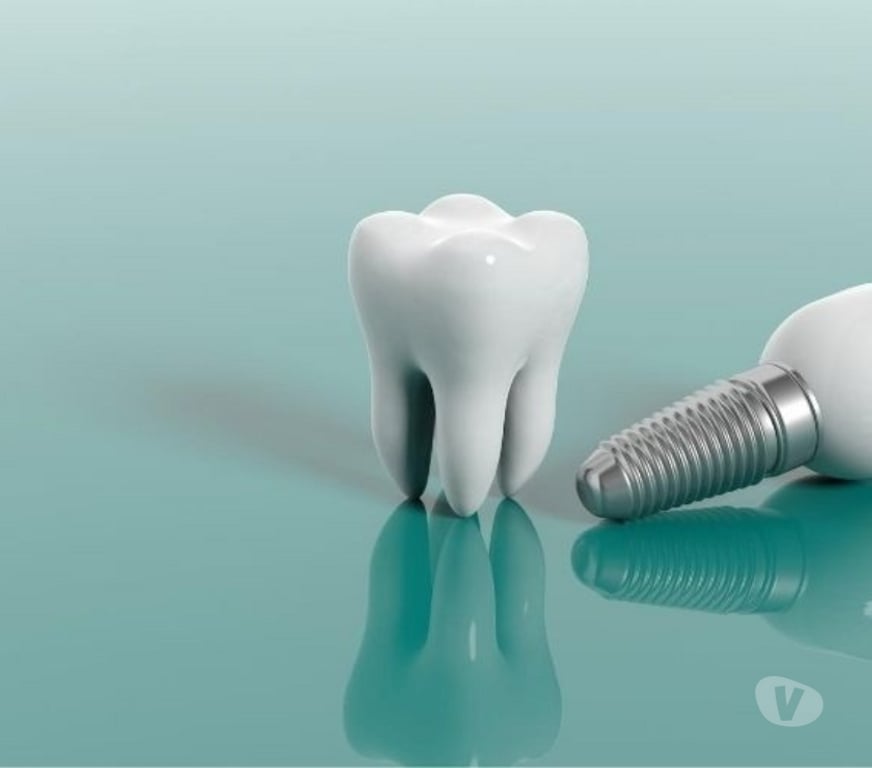 Masajes Santiago Providencia - Fotos de IMPLANTES DENTALES