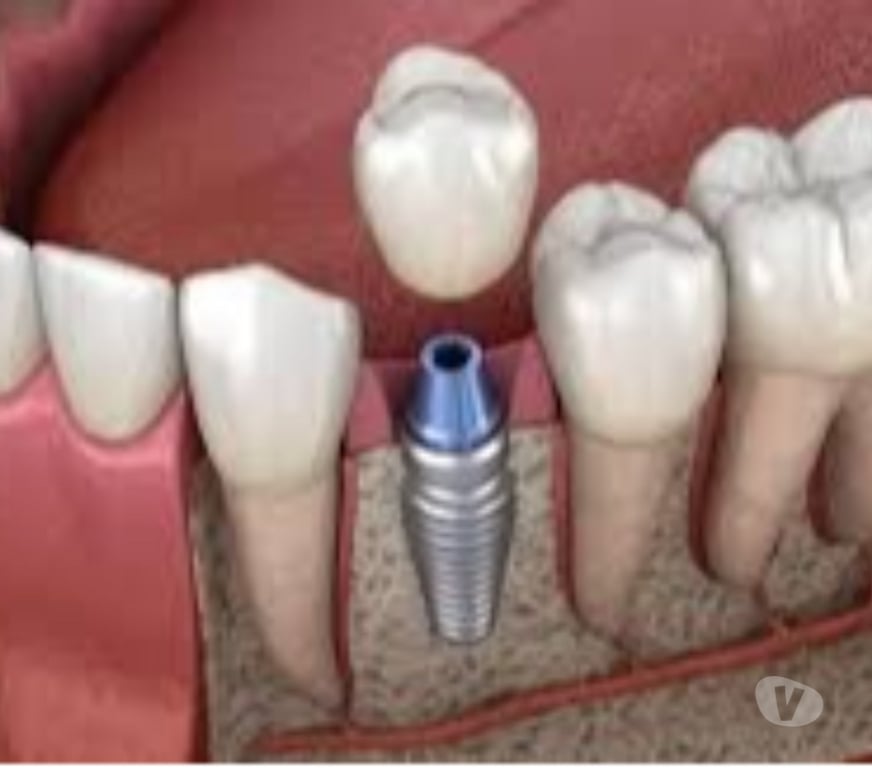 Masajes Santiago Providencia - Fotos de IMPLANTES DENTALES
