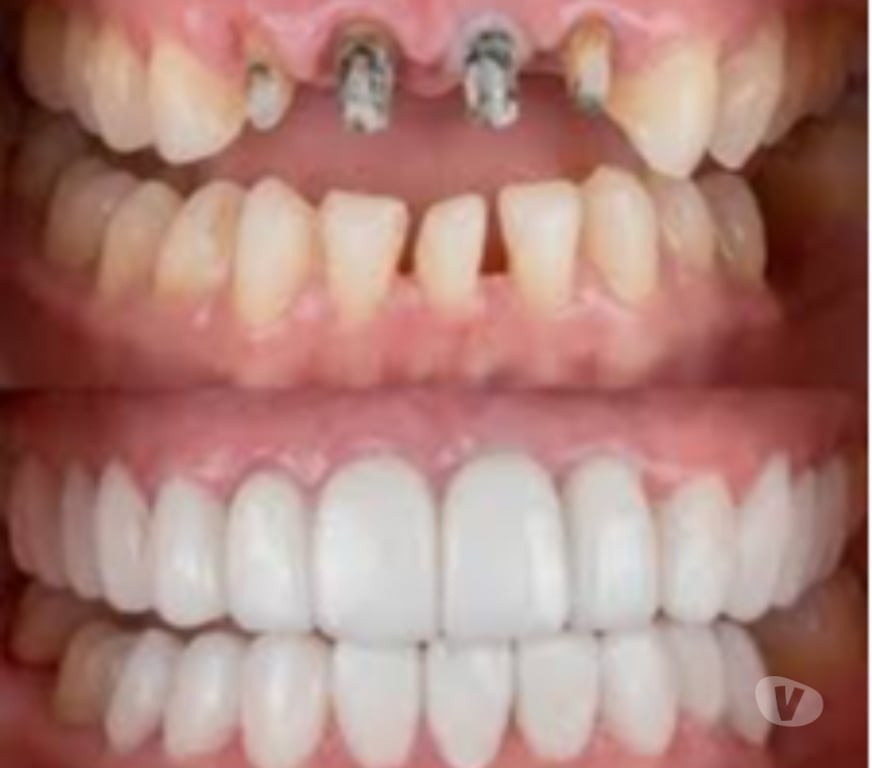 Masajes Santiago Providencia - Fotos de IMPLANTES DENTALES